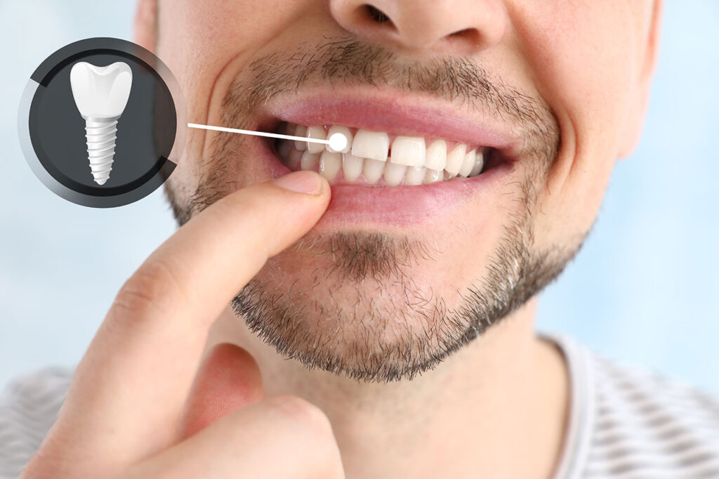 Dental Implant Dentist