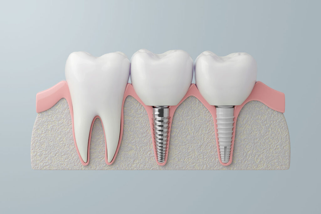 Dental Implants Support Crowns, Bridges, and Dentures