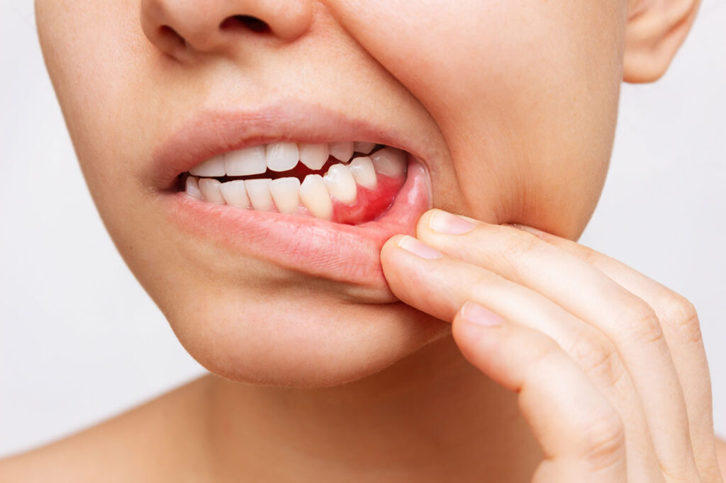 Gum Health, Periodontal Disease Treatment