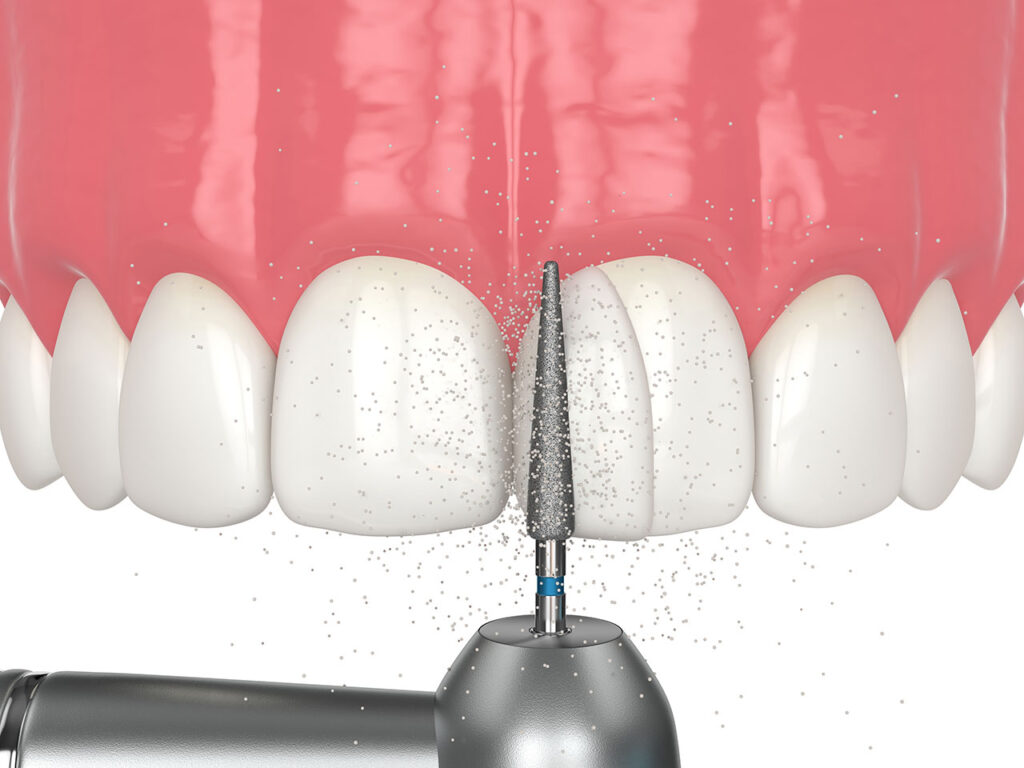 Dental Bonding, Shaping & Contouring Your Smile