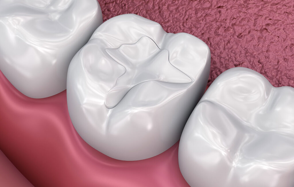 Dental Filling Rendering
