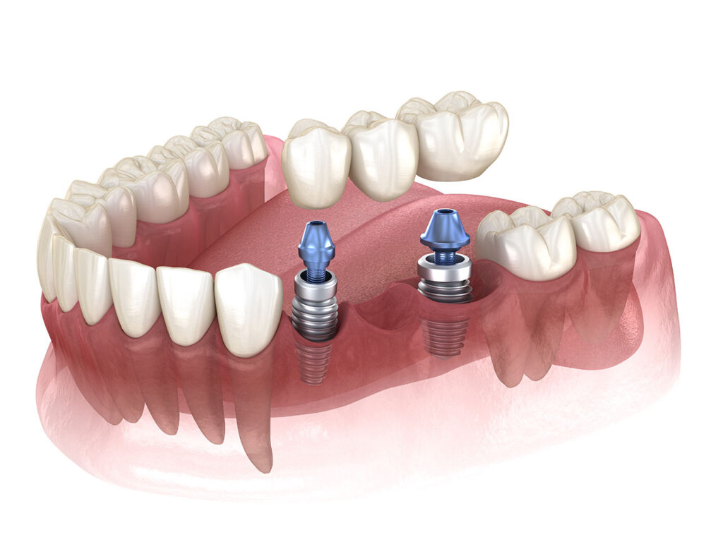 Dental Implant Bridge