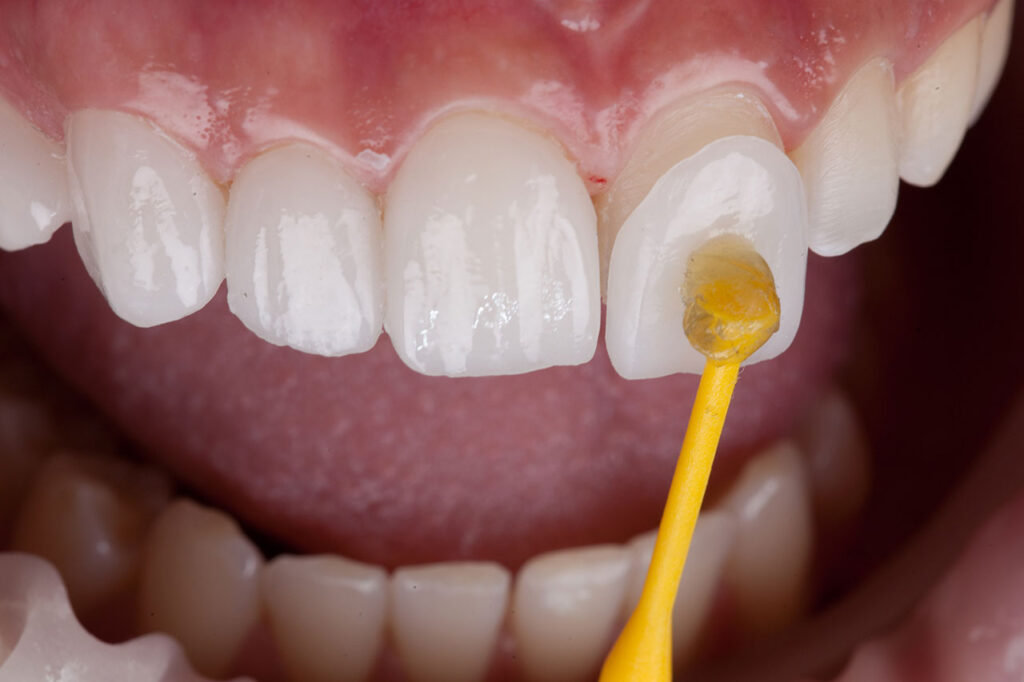 Dental Veneers vs. Bonding: Which Cosmetic Fix Fits Your Goals?