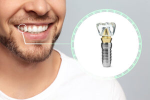 Benefits of Dental Implants